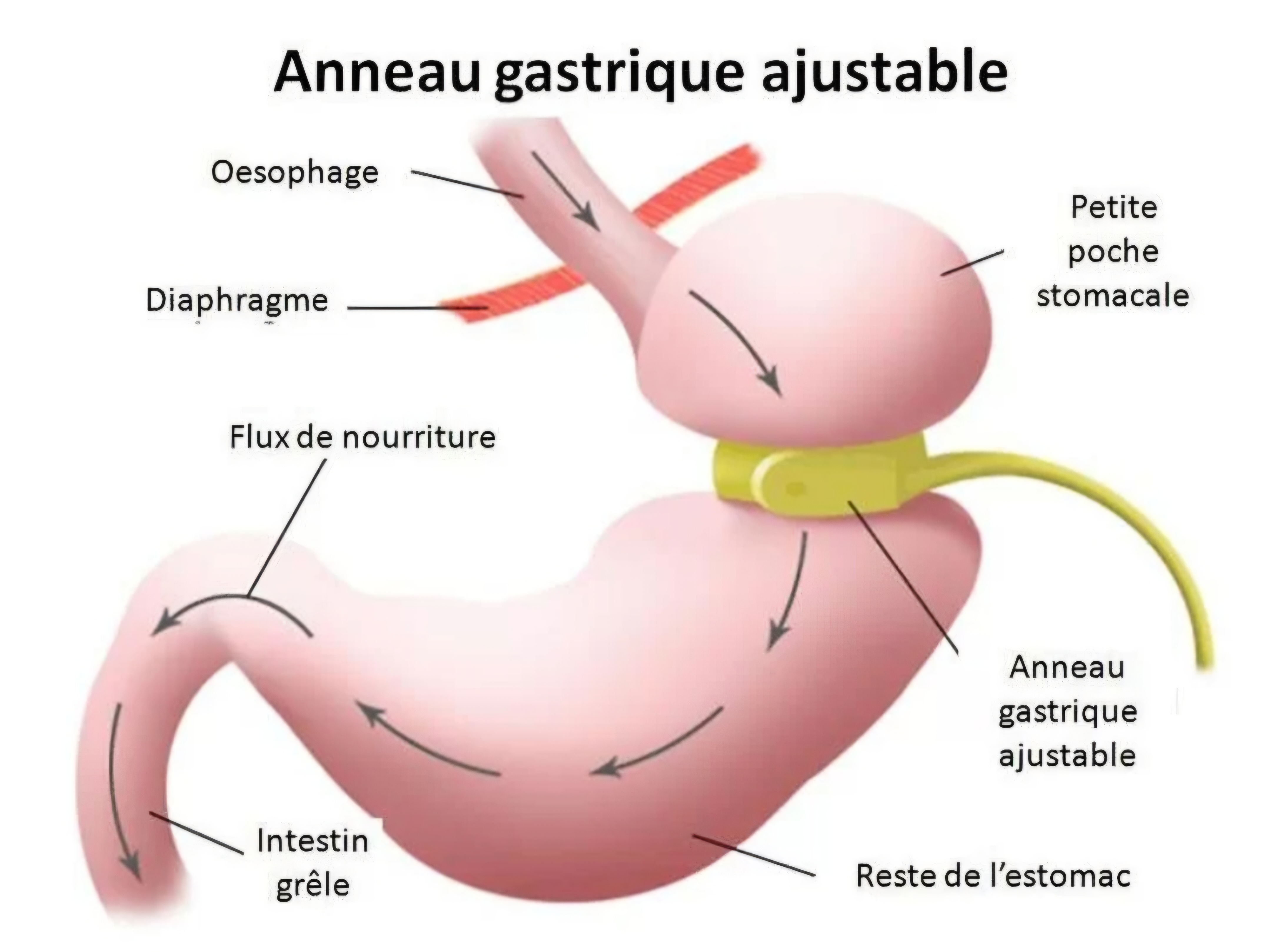 Anneau gastrique ajustable - schéma médical
